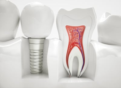 Pterygoid and Zygomatic Implants