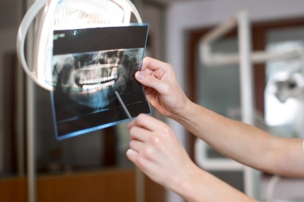 narrow implants vs bone augmentation.jpg narrow implants vs bone augmentation.jpg