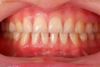 soft tissue management around dental implants.jpg