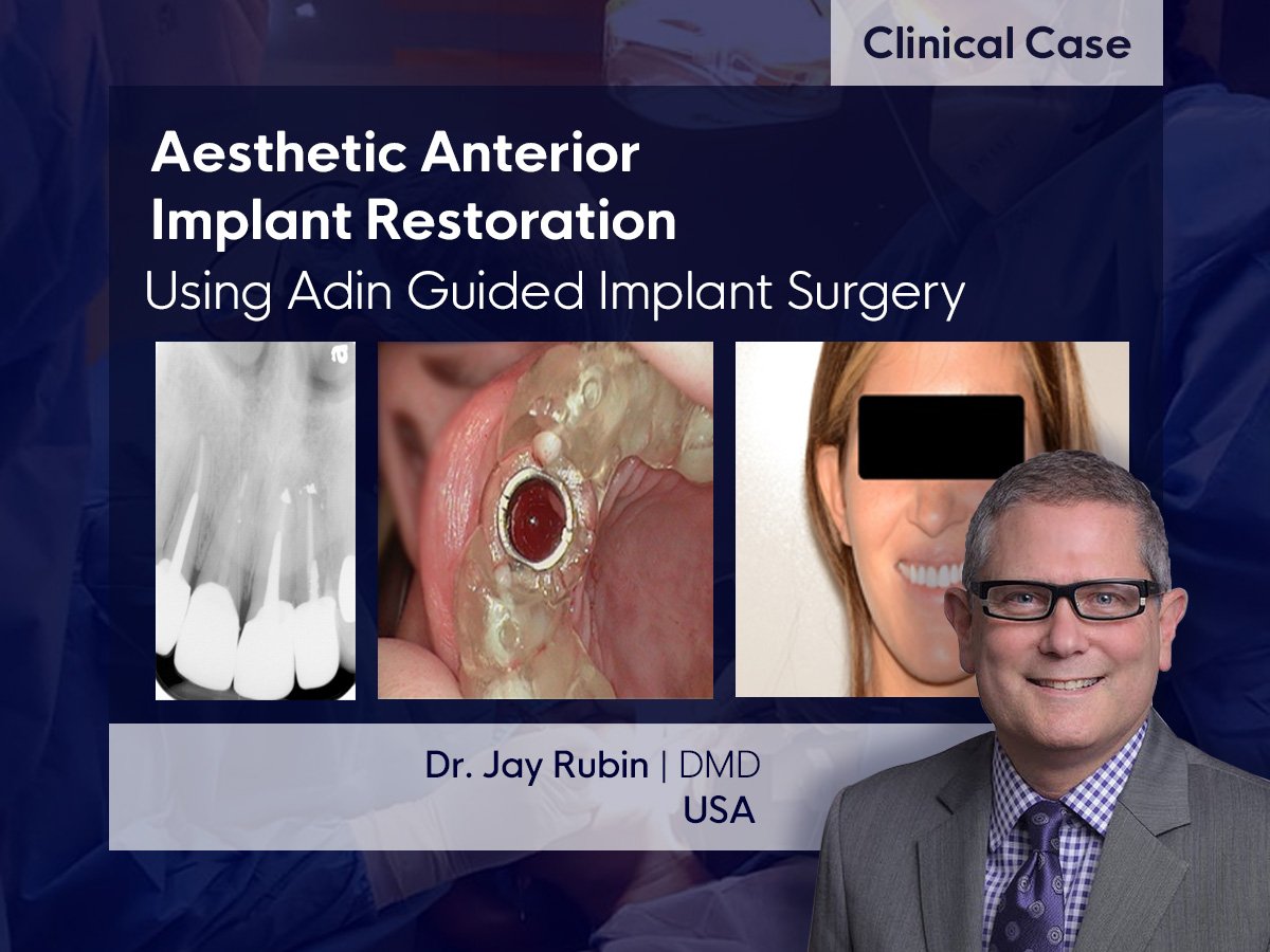 Aesthetic Anterior Implant Restoration: Using Adin guide
