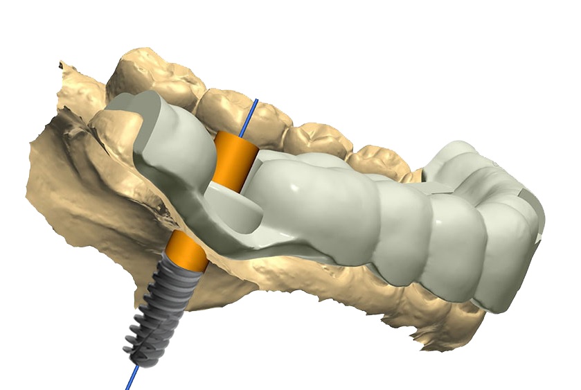 Computer-Guided Implant Placement - Myths and Facts