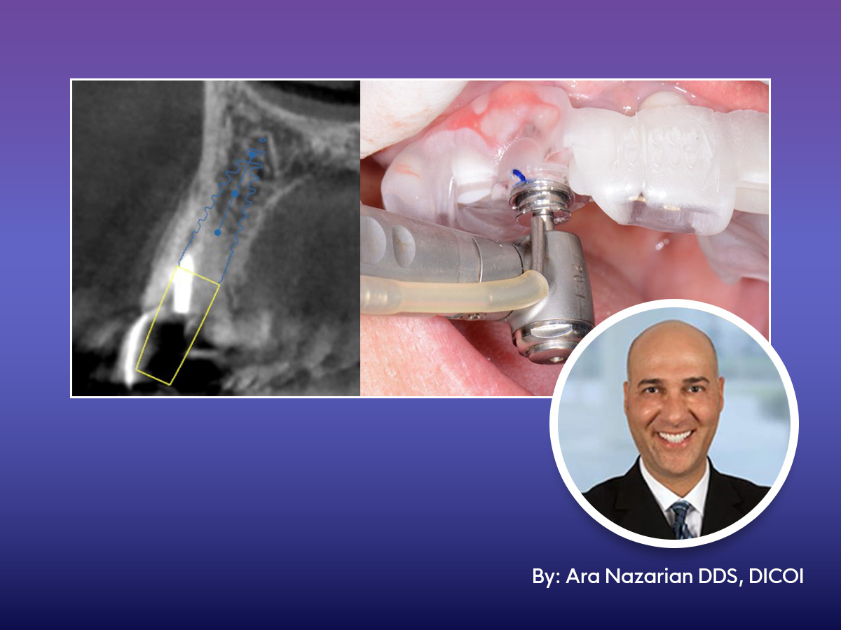 Single tooth restoration with Adinguide